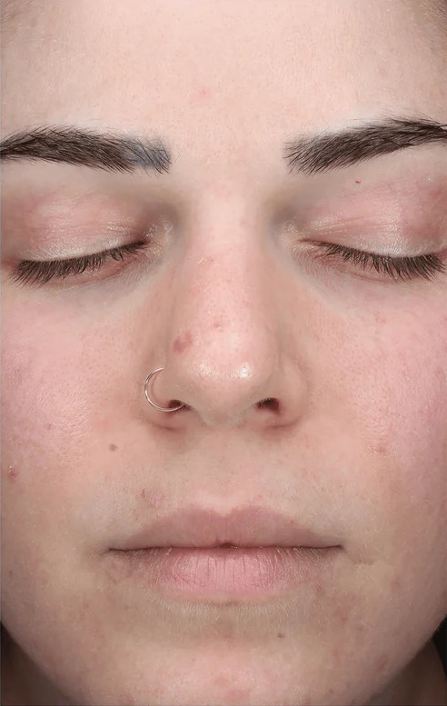 AlphaRet Clearing Serum